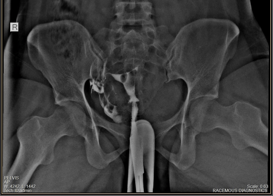 HYSTEROSALPINGOGRAPHY